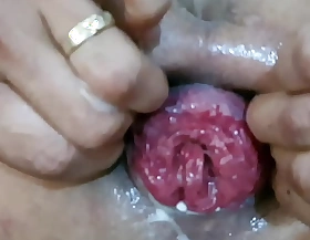 Vietnam anal prolapse and fuck